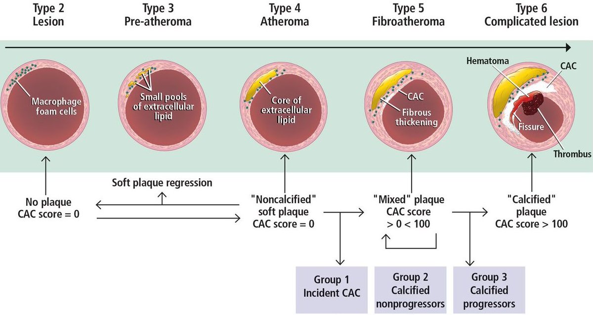 Atherosclerosis, the number one killer worldwide, begins much earlier than when it can be detected by coronary artery calcium (CAC) score