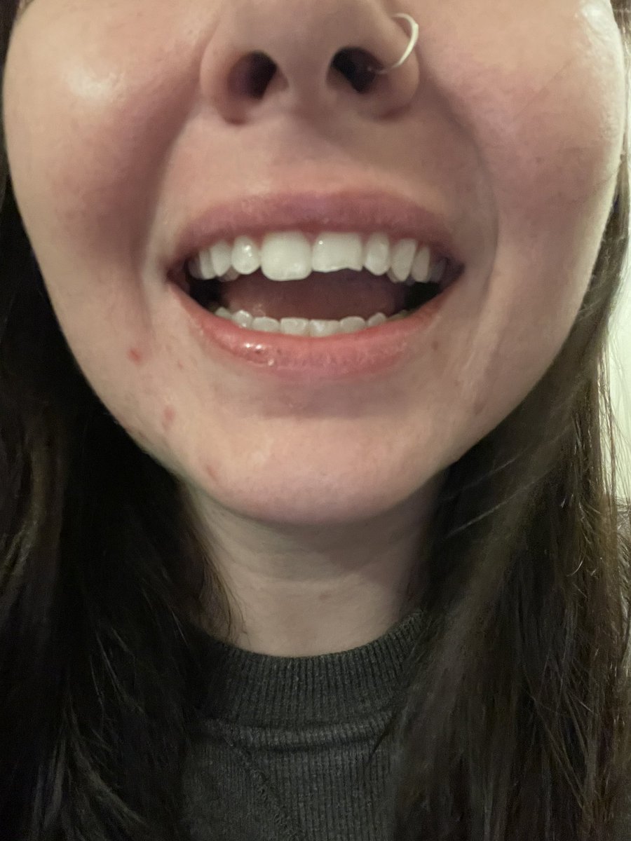 abbycarterr's tweet photo. So happy I went from buckwheat to fixed. Dr.Gibbs, you are the best https://t.co/aI0IuuatfS