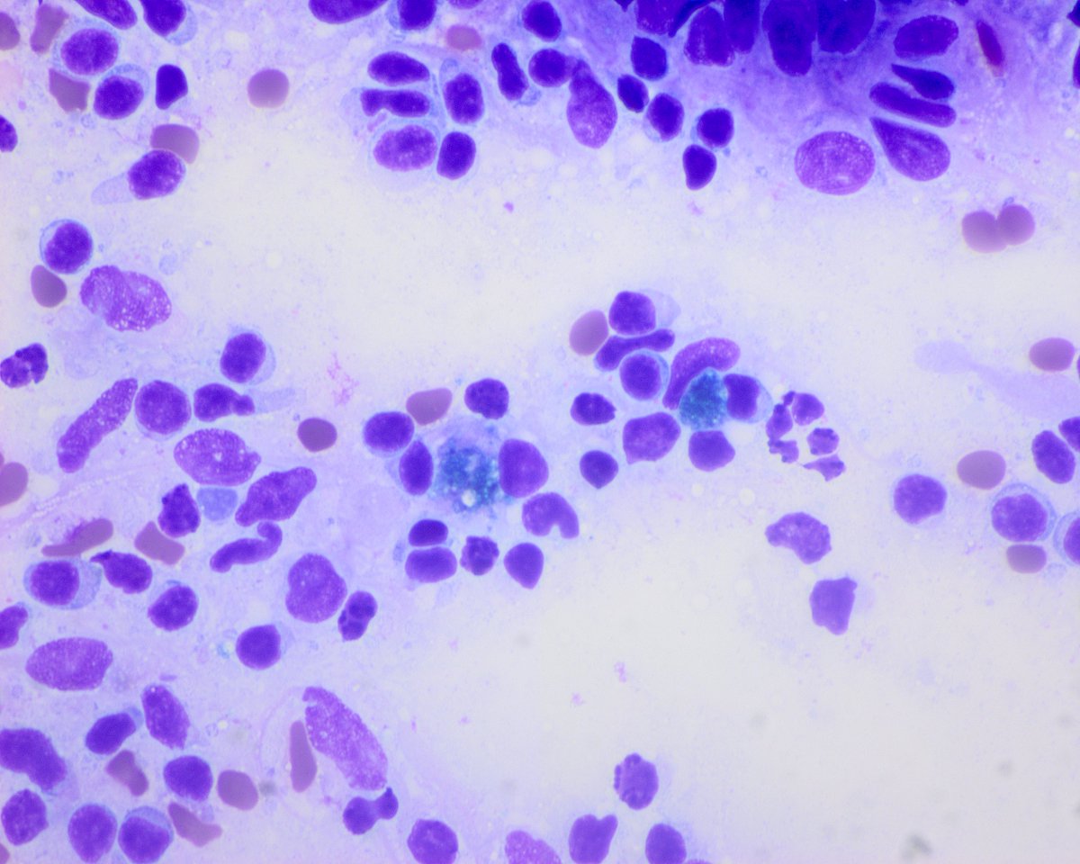 Part 3. Another case: Middle age man with psoriasis and axillary node. Large dendritic (interdigitating and Langerhans) cells will call your attention. When confluent they may vaguely resemble granulomas. Pigment is very helpful. No signs of follicular hyperplasia. @saada_vsaada