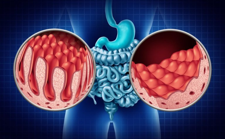 Gastroenterology Advisor (@gastro_advisor) on Twitter photo A celiac disease (CeD) program improves quality care metrics and resolves symptoms like diarrhea among patients with CeD. <a href="/DrewfordMD/">Drew Ford, MD 🩺</a> <a href="/Kaitlin_C_Payne/">Kaitlin Payne</a> <a href="/kendra_weekley/">Kendra Weekley, RD</a> <a href="/gardinier_david/">David Gardinier, RD</a> #GItwitter #gastroenterology
brnw.ch/21wJaFb A celiac disease (CeD) program improves quality care metrics and resolves symptoms like diarrhea among patients with CeD. <a href="/DrewfordMD/">Drew Ford, MD 🩺</a> <a href="/Kaitlin_C_Payne/">Kaitlin Payne</a> <a href="/kendra_weekley/">Kendra Weekley, RD</a> <a href="/gardinier_david/">David Gardinier, RD</a> #GItwitter #gastroenterology
brnw.ch/21wJaFb