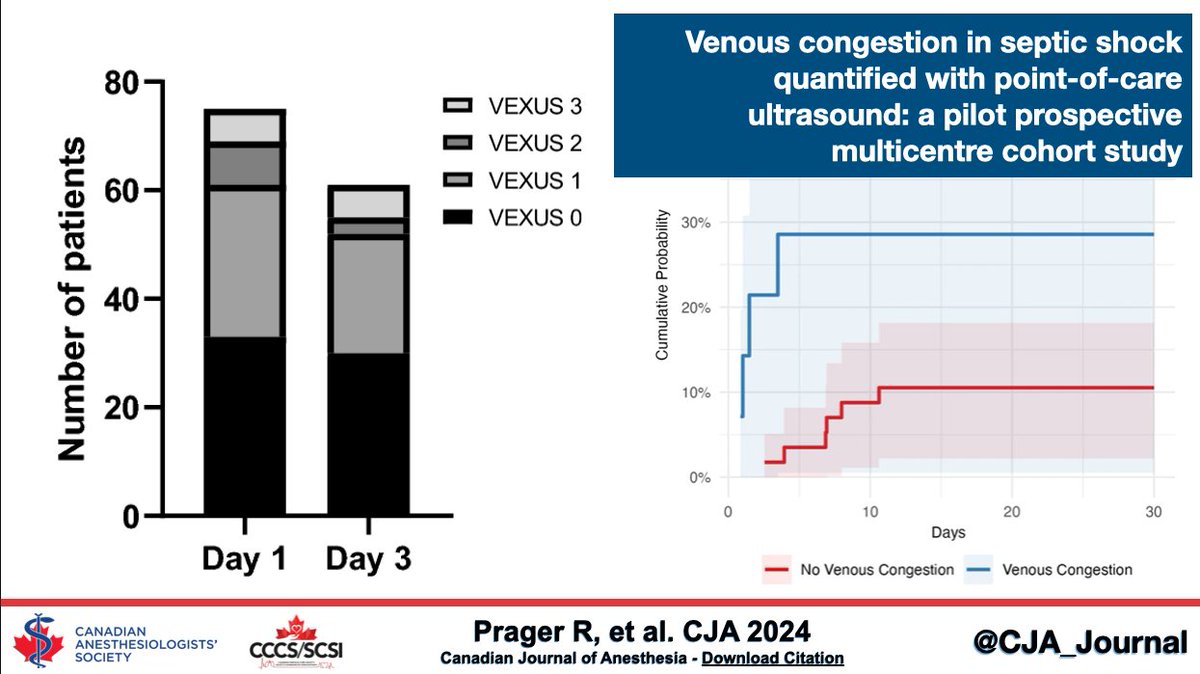 Venous congestion in septic shock quantified with point-of-care ultrasound: a pilot prospective multicentre cohort study - Canadian Journal of Anesthesia #CJA #CJA2024 #Anesthesia #Anesthesiology rdcu.be/dDXwv
