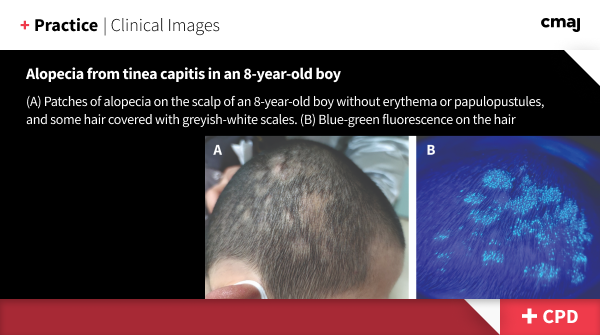 Tinea capitis, or “ringworm,” is a dermatophyte infection characterized by itchy lesions progressing to alopecia with visible scales on the scalp that occurs more commonly in children. ➡️ cmaj.ca/lookup/doi/10.…