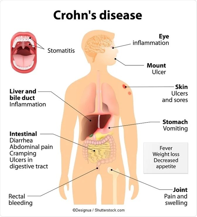 وش الباثوفسيولوجي لل renal stones في crohns disease 

“ليش تصير وكيف !!؟' 

المستوى: USMLE step 1 ⭐️⭐️⭐️