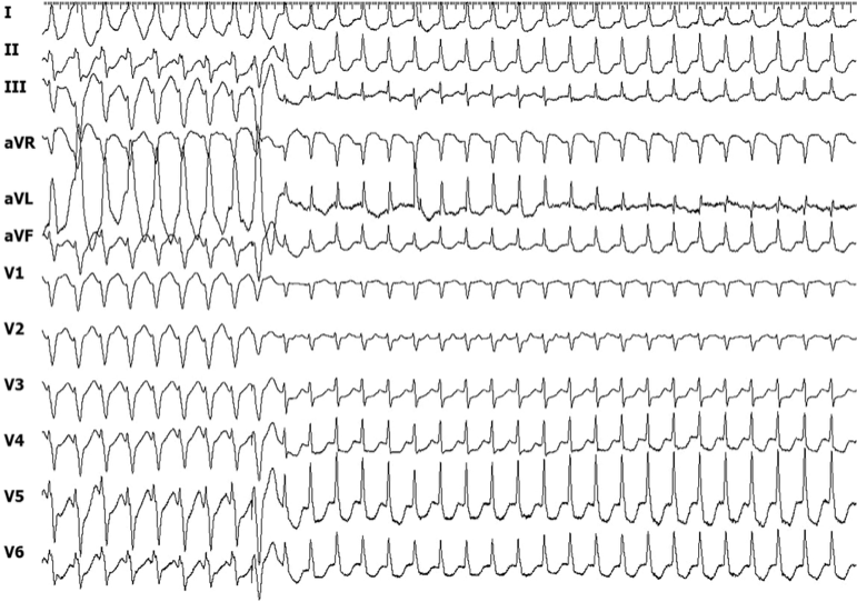 📌New in @JCardioEP 📷Transformation of a tachycardia following a His-refractory premature ventricular complex: What is the mechanism? by Vivekanantham et al. Read the solution: onlinelibrary.wiley.com/doi/10.1111/jc… @syamkumarmd @DrBradleyKnight @hcg_md @GiacomoMugnai @GrahamPeigh #EPeeps