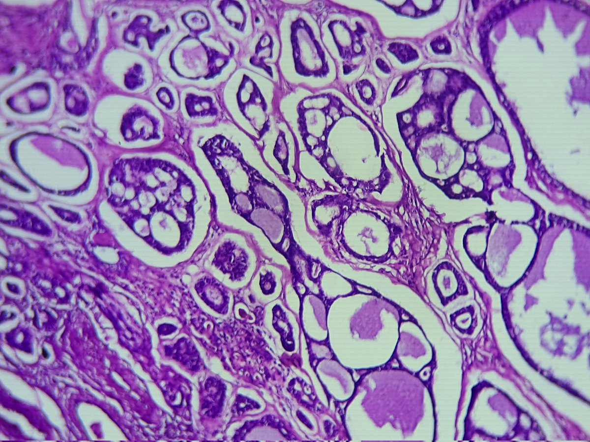 85984's tweet photo. Good evening everyone. Histopathology image of submandibular salivary gland mass in a 65 years old female. Thanks 

#PathTwitter #pathoutpic https://t.co/xP1cL4NLNa