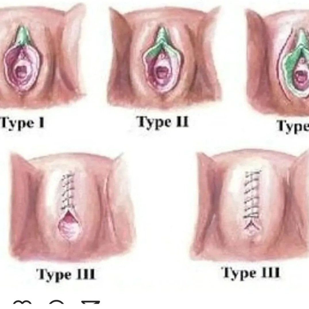 #nofgm my work is my life . I have passion, determination, and grit to continue . I never get  tired of working.  Its such important work. Over 200 million women and girls globally have been mutilated.  Over 11,000 girls mutilated globally each day.  Its horrific & cruel trauma