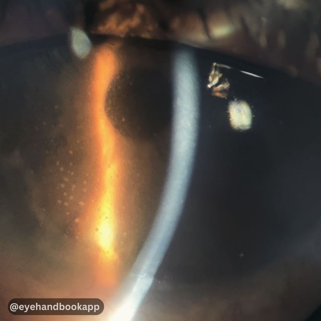 How will you manage this patient?
Check ALT (image description) for more info.

​#eyes #ophthalmology #optometry #retina #cornea #free ​#eyesurgery #oftalmologia #ophthalmologists #optometrists #eyedoctor #eyecare #eyehealth #nystagmus #uveitis