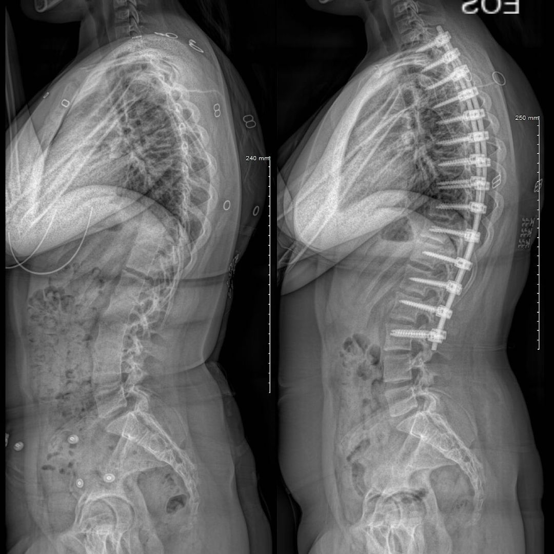 13 y/o Brianna was diagnosed with scoliosis during a routine checkup by her pediatrician. The curve in her spine had progressed to a point where surgery was necessary. Brianna has successfully recovered from surgery, & we’re extremely pleased with the results & progress!