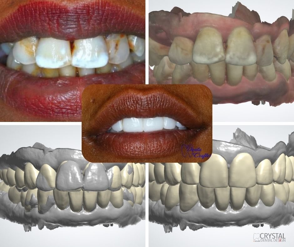 Full Mouth Rehabilitation 
With Dr. Nada Elsadig (DentaCrafter) 
#dentacrafters 
#crystaldentaldesign #fullmouthrehabilitation #digitaldentistry #digitaldental #dentists #dentaltechnicians #dentallab #dentallaboratory #fullmouth