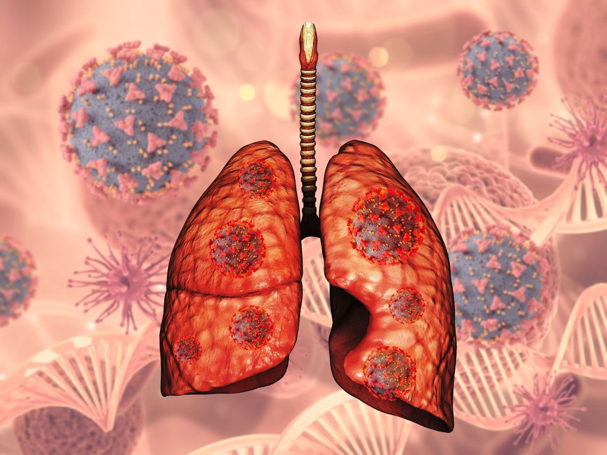 CT reveals influence of diabetes on COVID-19 severity #radiology #CTimaging #diabetes #COVID buff.ly/4ddNWov