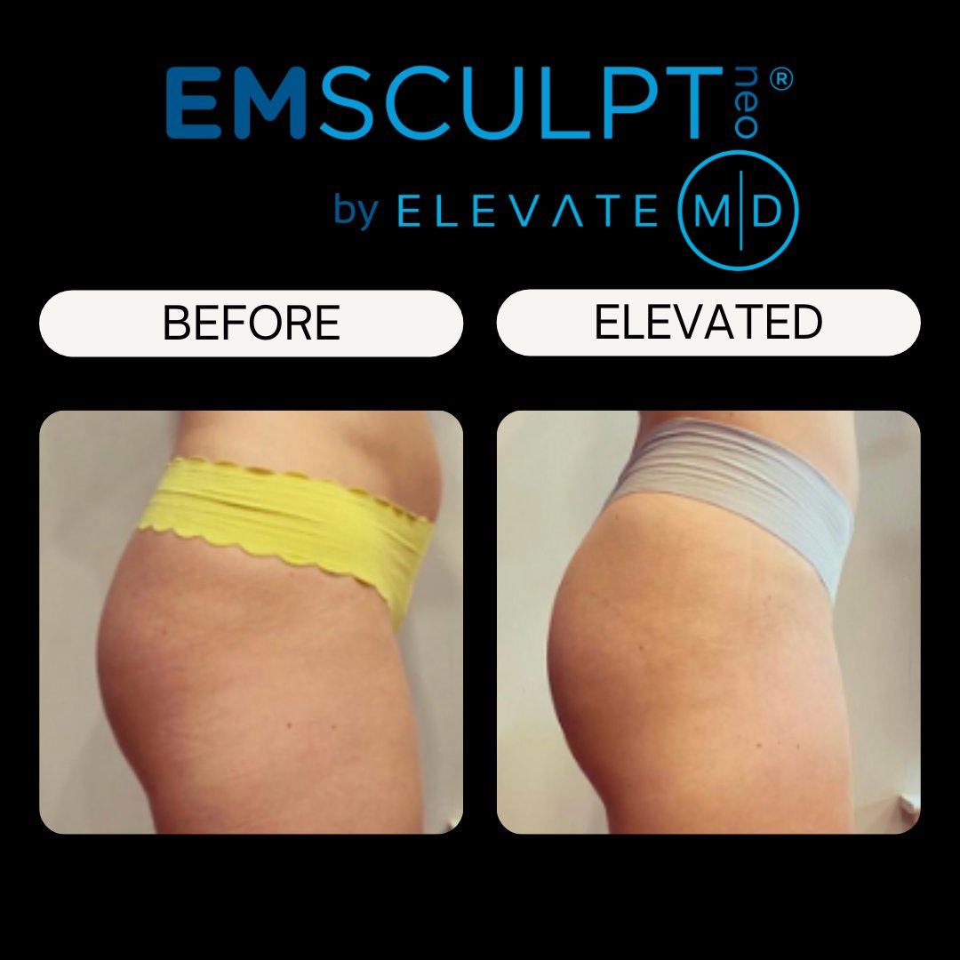 Finding a reputable Emsculpt Neo provider is essential for optimal results. At Elevate MD, our Body Contouring Specialists undergo continuous training to deliver the best possible results. Call (513) 882-7006 for a FREE consultation! 
#EmsculptNeo #BodyContouring #SummerBody