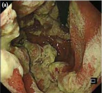 Severe gastritis with yellowish exudates after taking an antibiotic Guess what's the culprit?