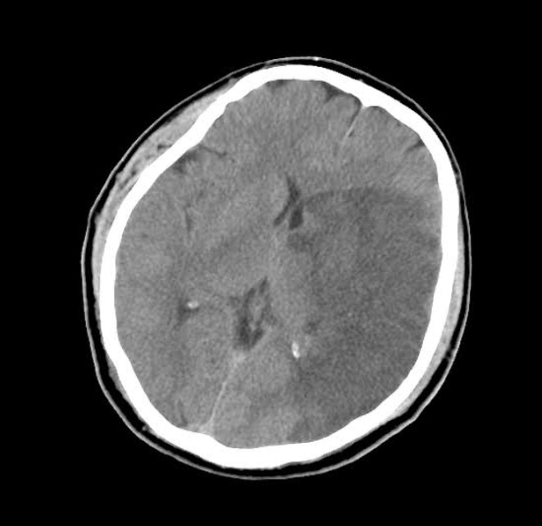 54 year old male patient presented with right sided weakness and aphasia. What's your diagnosis!! What will be your management!! #MedEd #MedX