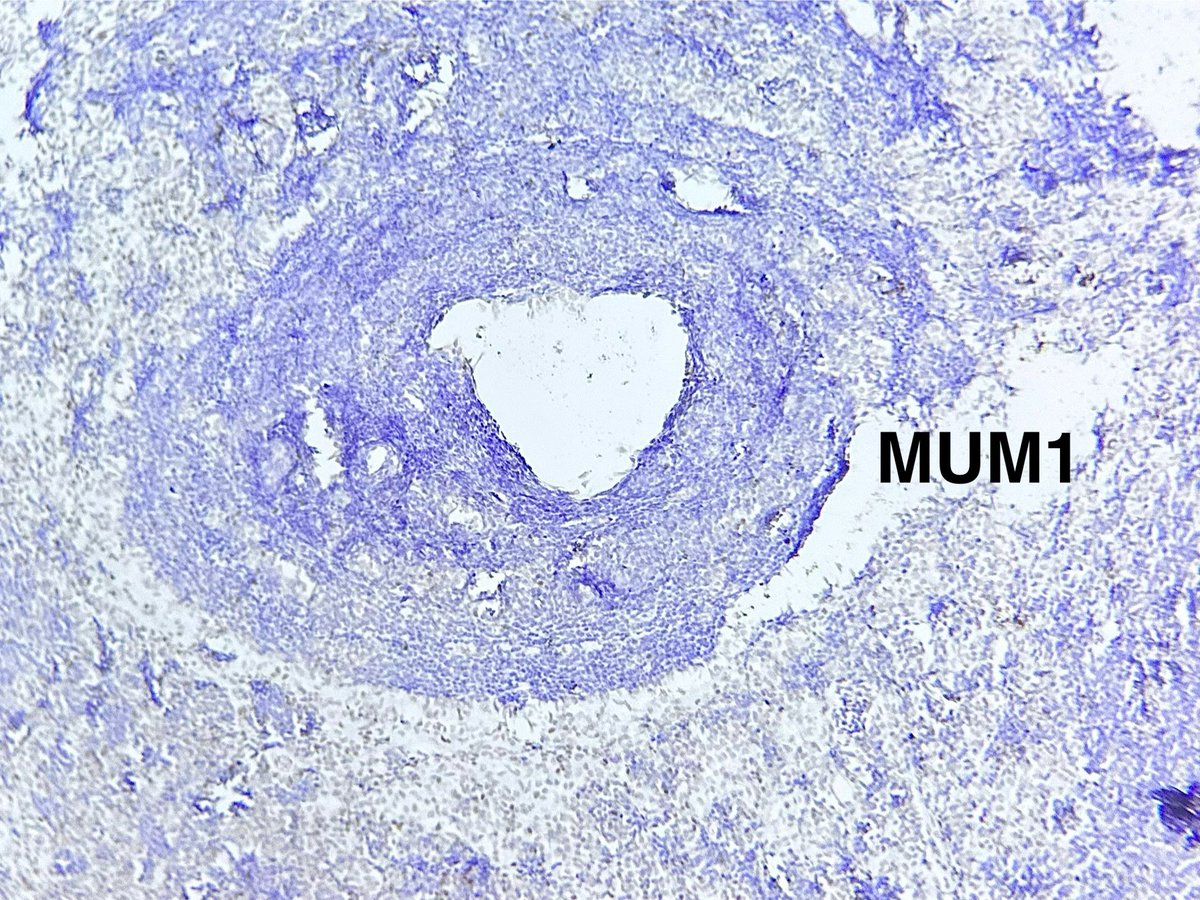 @teachplaygrub @neuropathology @NeuropathClinic @AdvNeuroPath @HopkinsNeuropth @Silvia_HdzMD @Radiopaedia @VHNguyenMD @PAT0logist @PeterKobalka @dr2hin @ElizabethEECH @emckaymd @Histopatolomon @rositadeolivop1 @JaredAhrendsen @ColegioOaxaca Negative IHC