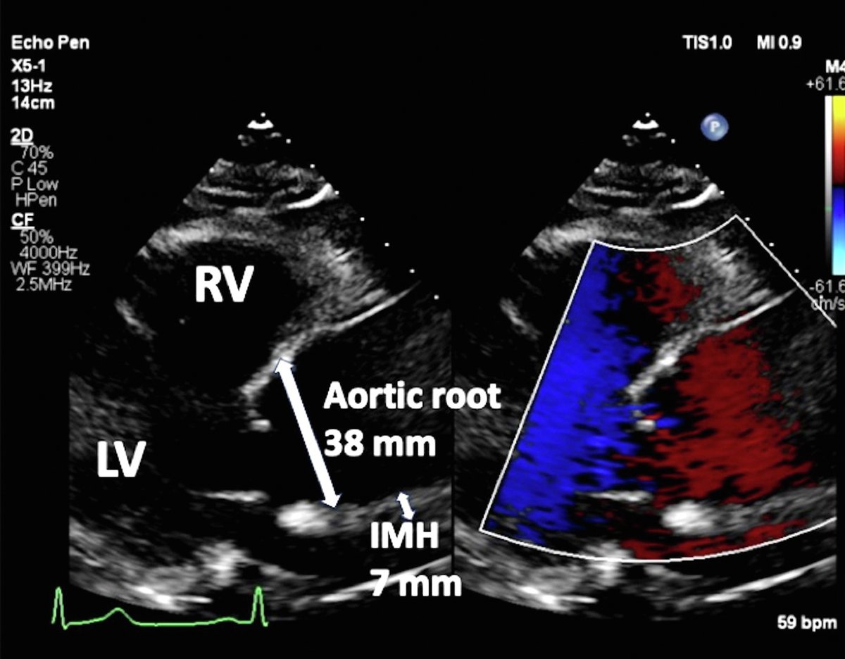 Type A aortic dissections (TAADs) involve the ascending aorta and are the most common and dangerous type. We report a successful case that illustrates the diagnosis and management of TAAD with progression to intramural hematoma (IMH). bit.ly/44e0aJK @CASEfromASE