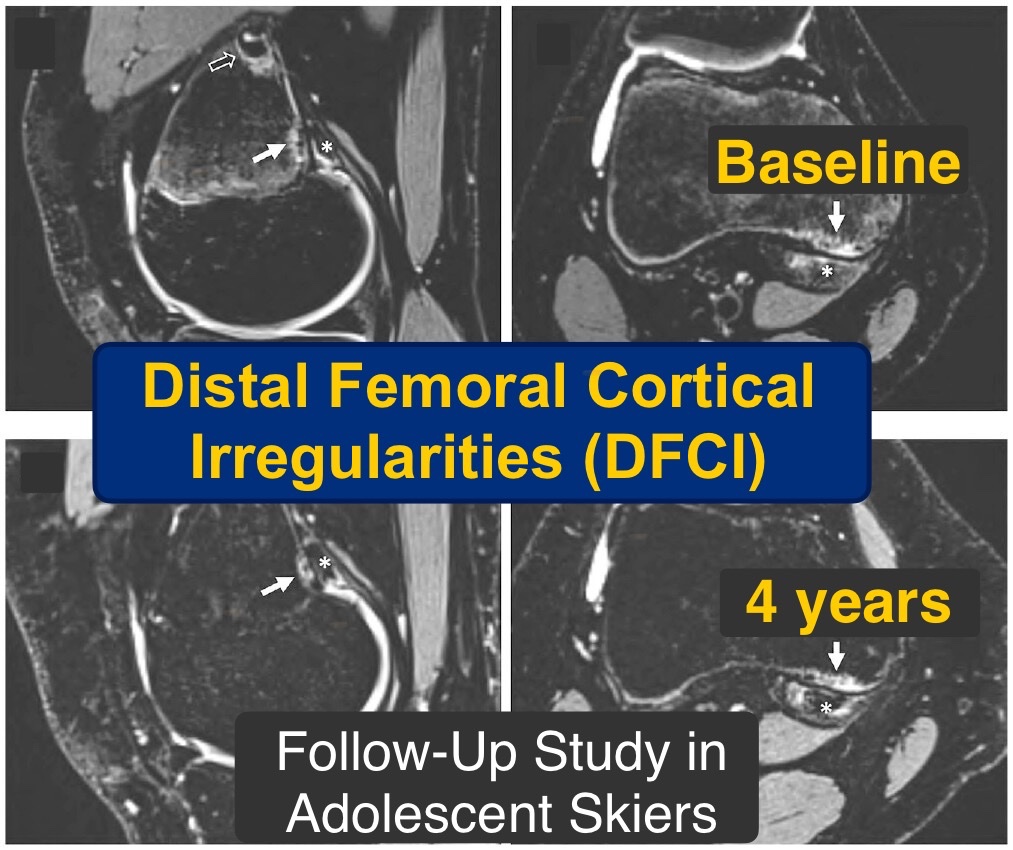 Download our new #OpenAccess article: doi.org/10.1177/036354…

👉 Tumor-Like Distal Femoral Cortical Irregularities (DFCI) of the knee remain a frequent finding after 4 years
👉 DFCIs do not disappear after skeletal maturation

@AJSM_SportsMed @derbalgrist @BalgristCampus #MSKrad