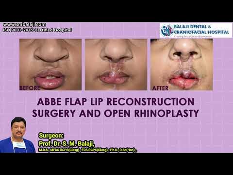 Abbe Flap Lip Reconstruction Surgery and Open Rhinoplasty 
youtu.be/o14mQZG7cFM 
#AbbeFlap #LipReconstruction #OpenRhinoplasty #CleftLip #CleftPalate