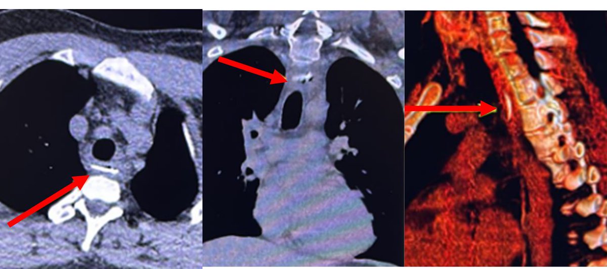 HNRadDASA's tweet photo. Oops 🐟🐟 Fish bone impacted at the esophagus! #HNRad https://t.co/k3ssfroLTH
