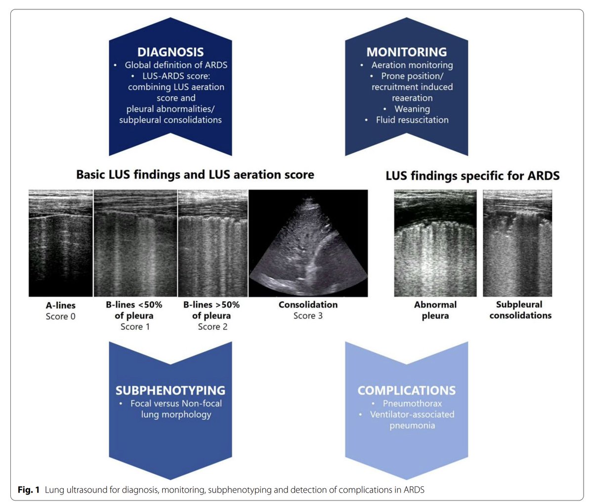 Lung ultrasound for diagnosis and management of ARDS LUS is invaluable for diagnosing and managing ARDS because it is non-invasive, bedside, and widely available in high- and low-resource settings. Intensive Care Med doi.org/10.1007/s00134…