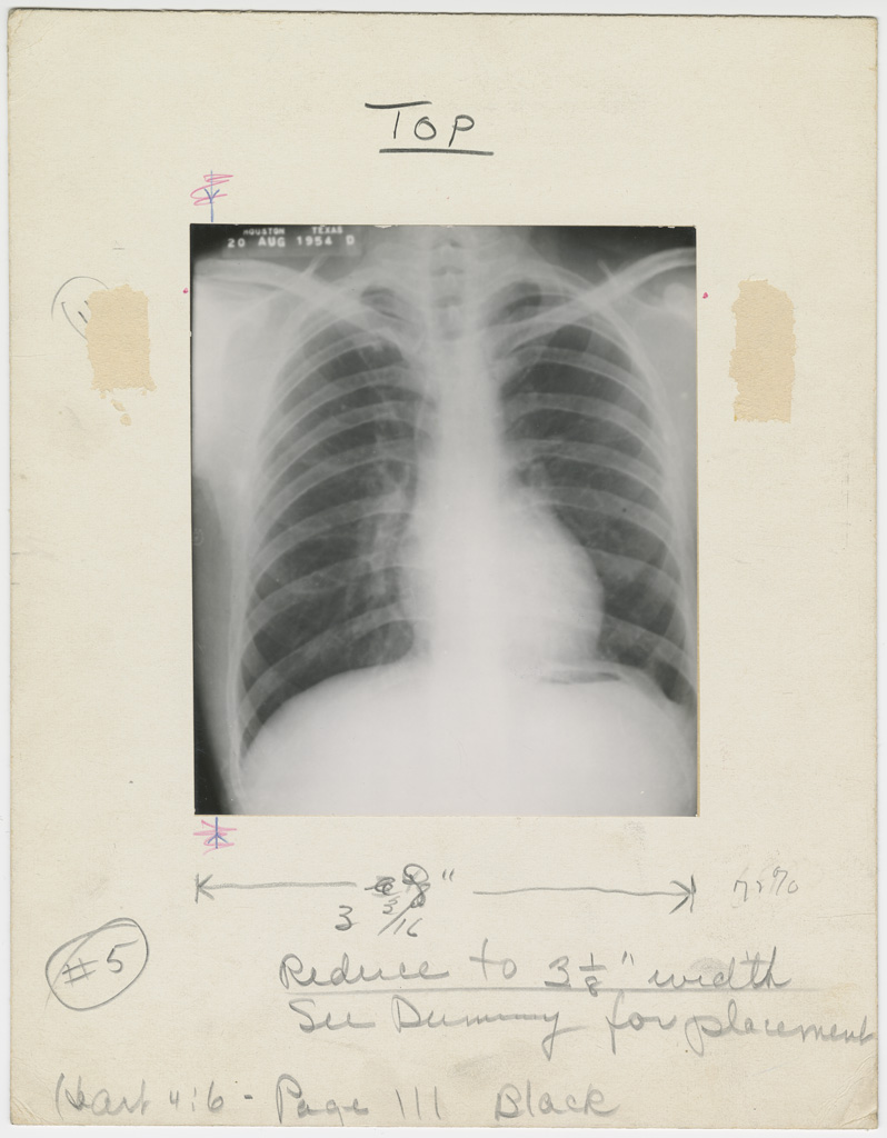 McGovernHRC's tweet photo. "Before and After" Heart Bulletin images:
Illustration, p. 111: “Pericardiectomy for Relief of Chronic Constrictive Pericarditis” X-ray image, November/December, 1955, Box 11, Folder 9, IC 094 Medical Arts Publishing Foundation, McGovern Historical Center, TMC Library https://t.co/JMy707QpNU