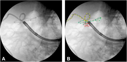 In iNNOVATIONS: iMAGES from iGIE: Firkins and Siddiki execute 'Doubling-down: LAMS-in-LAMS rescue of a migrated cholecystogastrostomy stent.' igiejournal.org/article/S2949-… @SFirkins_MD @MetabolicEndo @gutdoc18