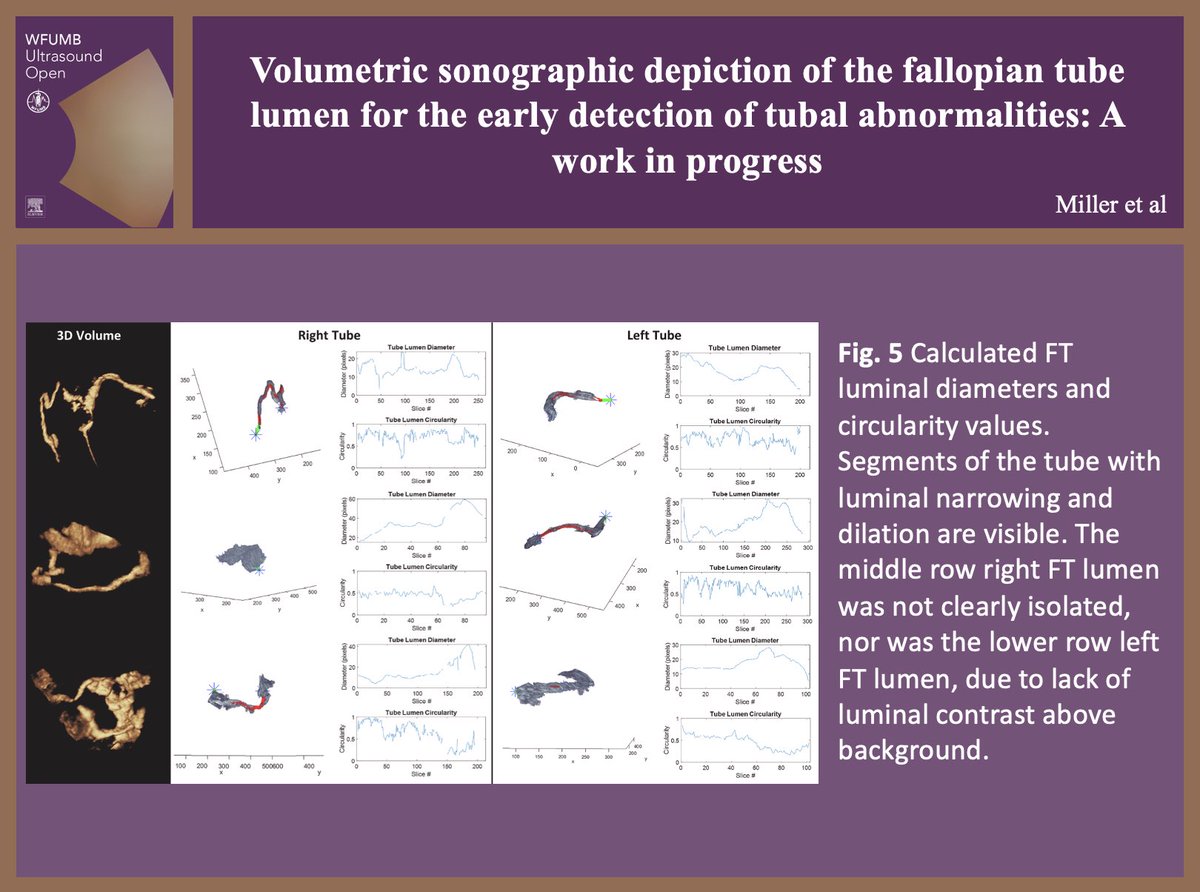 WFUMBOpen's tweet photo. 💭Recent understanding of #OvarianCancer has identified the distal FT as the site of early tumorigenesis. This study outlines #Ultrasound techniques for volumetric depiction of the FT lumen.

Read it at: https://t.co/unLuUvrRtO

Submit your article at: https://t.co/Ib6dijnbR0 https://t.co/588J8wHmy4