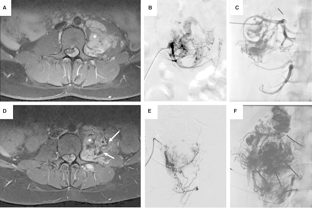 Comparison of patients with various PVs in genes of the RAS/MAPK pathway reveals potential associations with certain morphological and clinical phenotypes. #AHAJournals <a href="/VanessaFSchmidt/">Vanessa F. Schmidt, MD, MHBA, EDiR</a> ahajournals.org/doi/10.1161/JA…