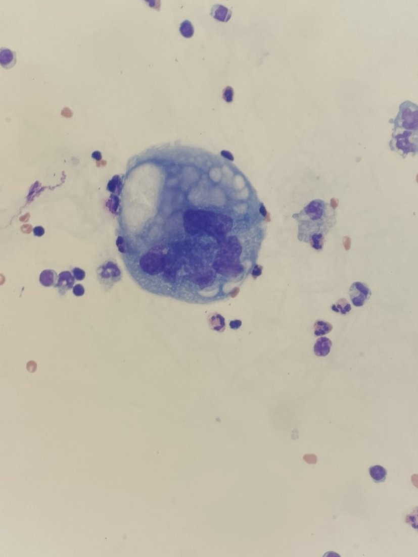 These cells are out 👩‍⚖️ of👩‍⚖️order👩‍⚖️

Ascitic fluid in a patient with metastatic serous carcinoma.

#Cytopathology #PathTwitter #PathX #thatcellaintright