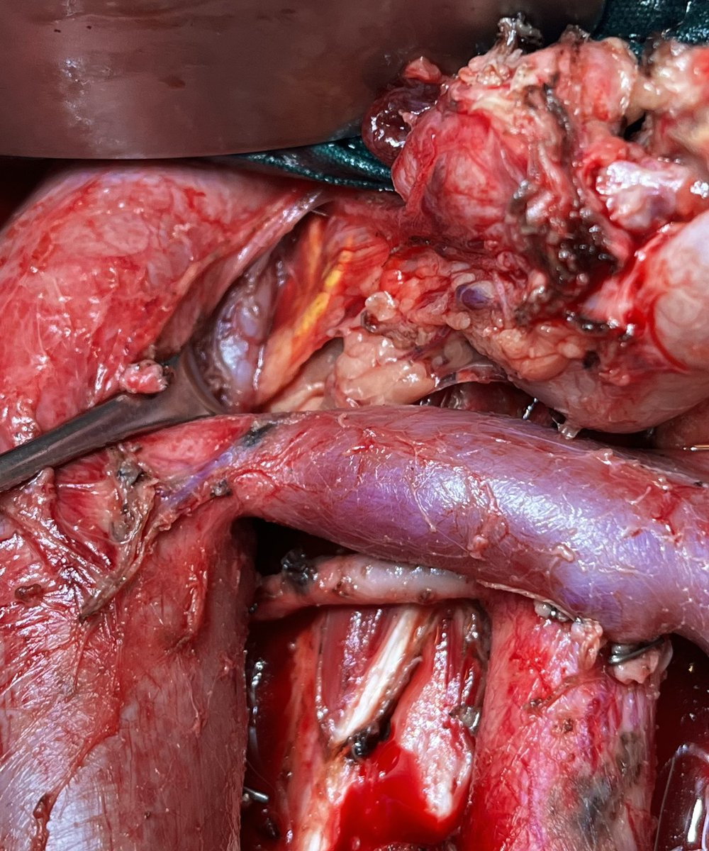 TCa D25 : conventionally the template of #RPLND ends at renal hilum .. be watchful for suprahilar/retrocrural nodes .. a favourite ‘sneak in’ zone.. accessible @GTumors @TestesCancer @MahendraTMH @dramandeeparora @Amitabh49547601 @anandoncologist @YAUpenile_tesCa