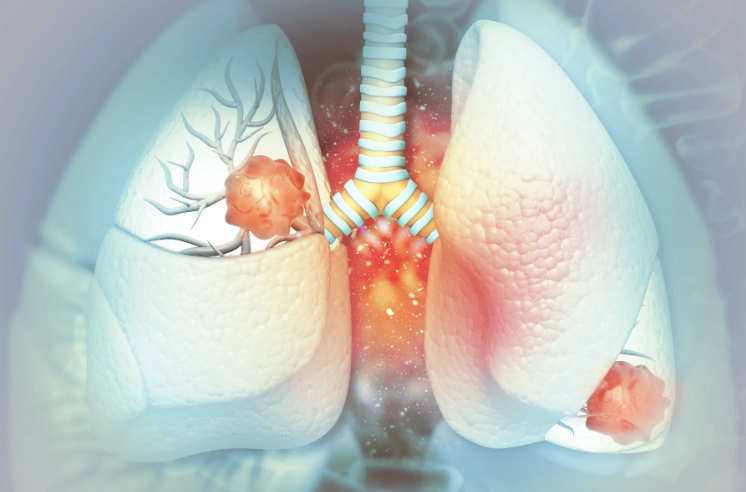 Nogapendekin alfa led to overall survival improvements in patients with second- and third-line #NSCLC who progressed after checkpoint inhibitors + chemo, according to data from the phase 2b QUILT-3.055 study. #LCSM targetedonc.com/view/nogapende…