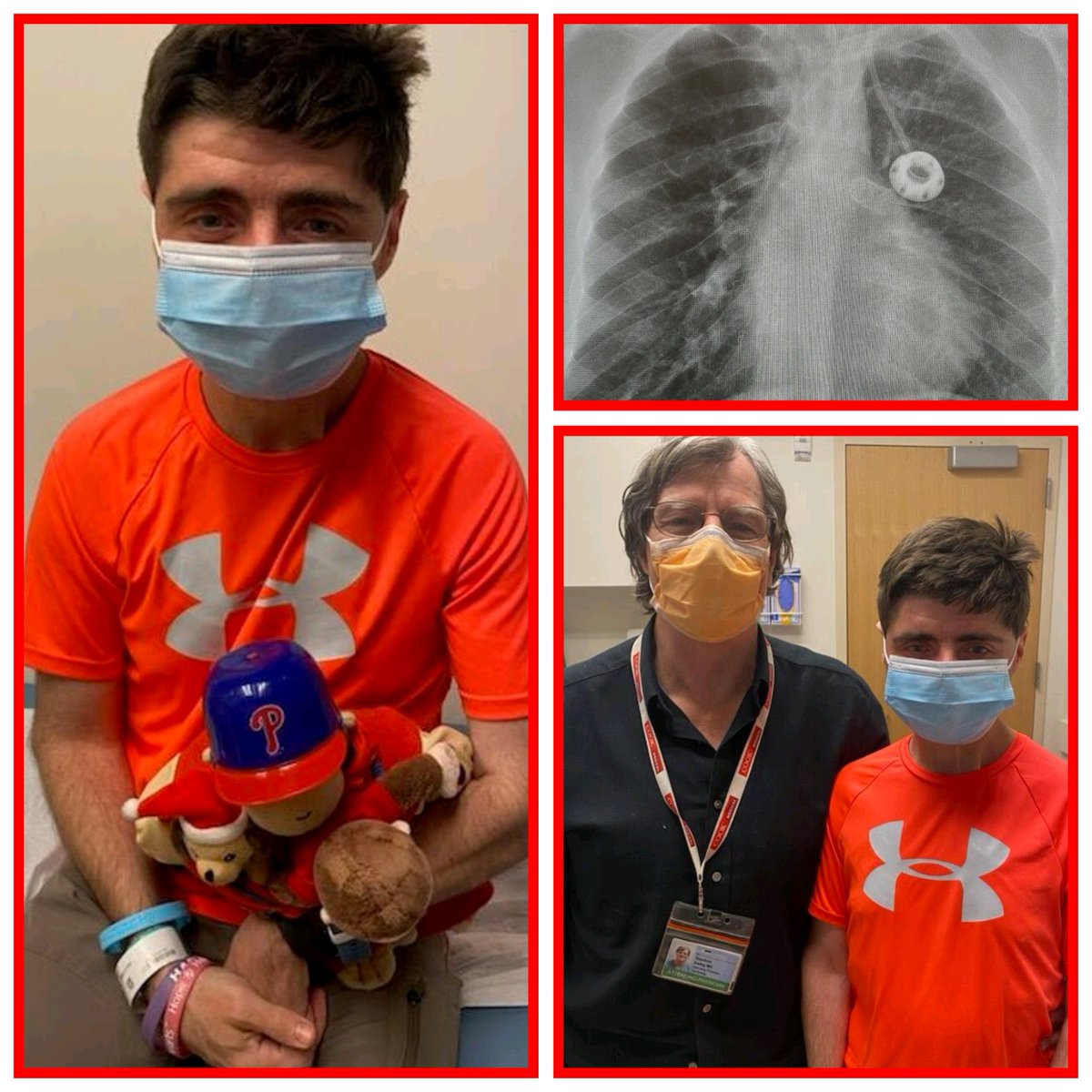 On a normal day his #CHD #ACHD  lungs: 'Course interstitial lung markings, prominent central pulmonary vasculature, perihilar opacities' X-ray/CT never shows aorta pulmonary collaterals that cause hemoptysis or plastic bronchitis casts that he coughs up next day. @HeartCare4Kids