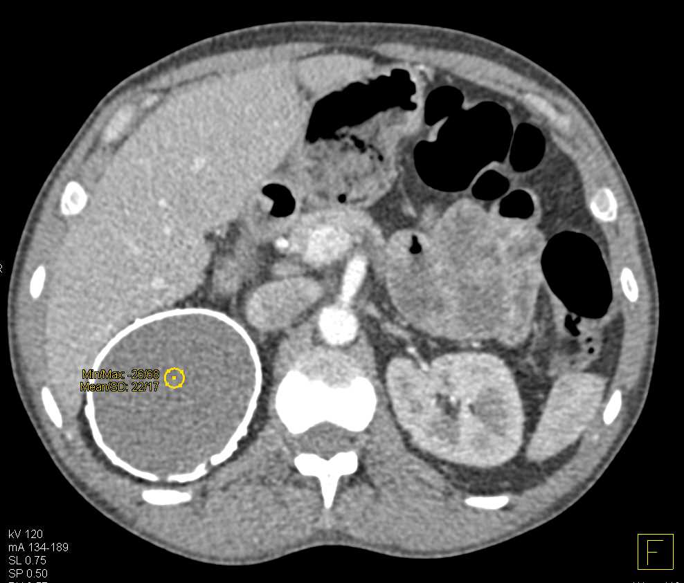 Calcified Cyst Right Kidney: ctisus.com/teachingfiles/…