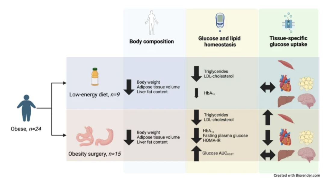 Both obesity surgery (OS) & a low-energy diet led to similar weight reductions after 4 wks, but only OS improved fasting plasma glucose and insulin resistance, influencing tissue-specific glucose fluxes. #ObesityResearch #InsulinSensitivity @uppsalauni tinyurl.com/yc7c4bfd 🔓