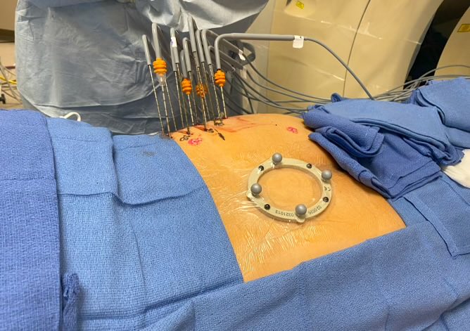 Congratulations ⁦<a href="/Gina_Landinez_/">Gina Landinez</a>⁩ for the first robotic assisted bone #cryoablation in the US <a href="/MiamiVasc/">Miami Vascular</a>⁩ ⁦<a href="/MiamiCancerInst/">Miami Cancer Institute Research</a>⁩ ⁦<a href="/SIRspecialists/">Society of Interventional Radiology</a>⁩ ⁦<a href="/womenirads/">WomeninIR</a>⁩ ⁦⁦<a href="/QuantumSurgical/">Quantum Surgical</a>⁩ #ablation ⁦<a href="/bostonsci/">Boston Scientific</a>⁩ ⁦<a href="/bsc_io/">Peter Pattison</a>⁩