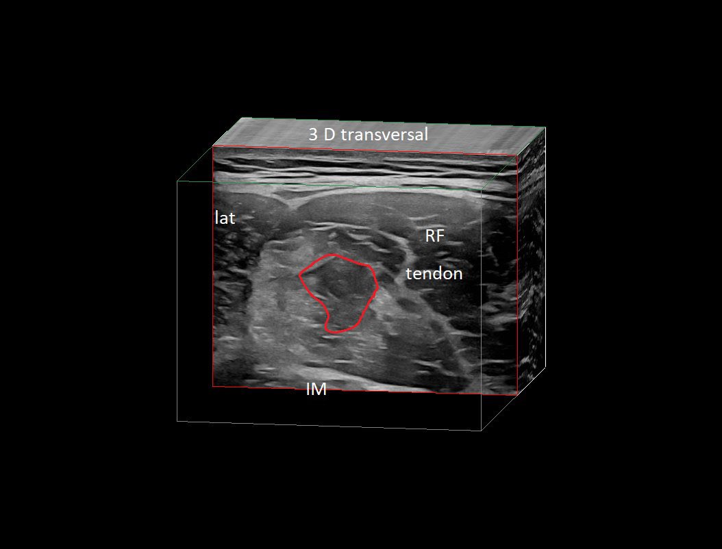 SportklinikBern's tweet photo. #intramuscular #muscleinjury of the #rectusfemoris —> #ultrasoundguidedinjection with #arthrexprp- #mskus #pocus #pocushub #GElogiqE10r3 #stayinthegame 🙌🇨🇭💉 https://t.co/CRKx1GGmhP