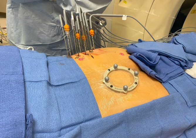 Congratulations ⁦@Gina_Landinez_⁩ for the first robotic assisted bone #cryoablation in the US!! ⁦@MiamiVasc⁩ ⁦@MiamiCancerInst⁩ ⁦@BaptistHealthSF⁩ ⁦@SIRspecialists⁩ ⁦@QuantumSurgical⁩ ⁦@bostonsci⁩ ⁦@bsc_io⁩