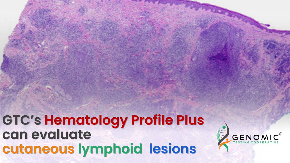 Order HemePlus on skin biopsies and resolve the diagnostic dilemma of cutaneous lymphoid lesions.

genomictestingcooperative.com/genomic-tests/…
