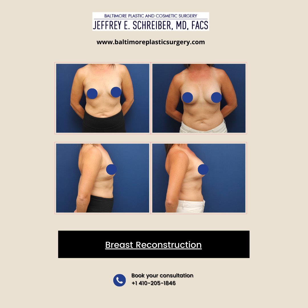 A 44-year-old woman recently underwent breast reconstruction surgery to correct a lumpectomy defect. The procedure was successful, and she now has more balanced and natural-looking breasts.

Call (410) 205-1846 to schedule a consultation today.

#breastreconstruction