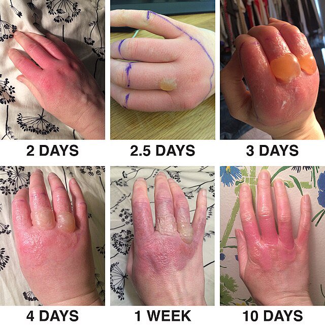 caveofbeauty's tweet photo. Please RT and tell everyone you love that if they’re gonna be outside drinking margaritas or eating citrus fruits this summer, to WEAR SUNSCREEN so they don’t get phytophotodermatitis ⚠️ 

It’s an EXTREMELY(!) painful chemical reaction that occurs when citrus fruits on your skin are exposed to UV rays. 

Yes, it can happen to Black people too. Here’s how it looks ⬇️