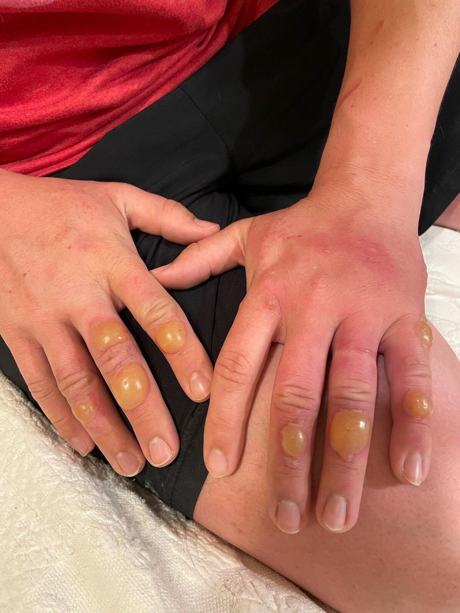caveofbeauty's tweet photo. Please RT and tell everyone you love that if they’re gonna be outside drinking margaritas or eating citrus fruits this summer, to WEAR SUNSCREEN so they don’t get phytophotodermatitis ⚠️ 

It’s an EXTREMELY(!) painful chemical reaction that occurs when citrus fruits on your skin are exposed to UV rays. 

Yes, it can happen to Black people too. Here’s how it looks ⬇️