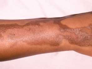 caveofbeauty's tweet photo. Please RT and tell everyone you love that if they’re gonna be outside drinking margaritas or eating citrus fruits this summer, to WEAR SUNSCREEN so they don’t get phytophotodermatitis ⚠️ 

It’s an EXTREMELY(!) painful chemical reaction that occurs when citrus fruits on your skin are exposed to UV rays. 

Yes, it can happen to Black people too. Here’s how it looks ⬇️