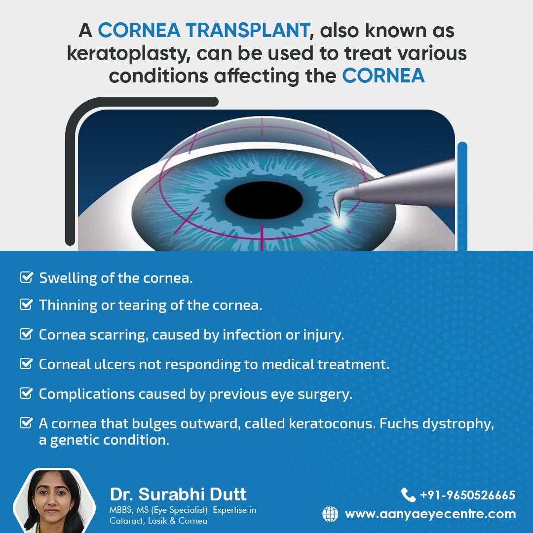 A cornea transplant, also known as keratoplasty, can be used to treat various conditions affecting the cornea.
- Thinning or tearing of the cornea

More Info Visit: aanyaeyecentre.com

#corneatransplant #ophthalmology #eye #cornea #eyedoctor #aanyaeyeclinic