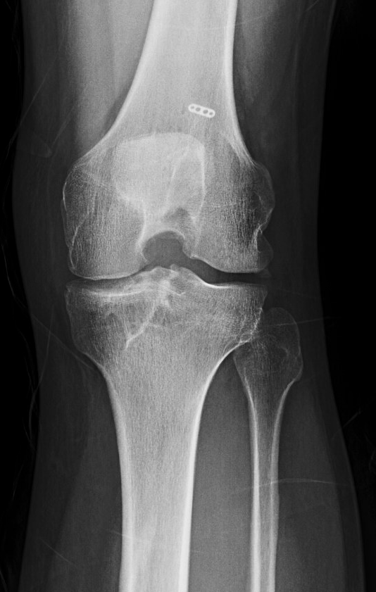 ACL done in 2010 by another surgeon. Seeing me for..... his other knee. This one is stable and works perfectly