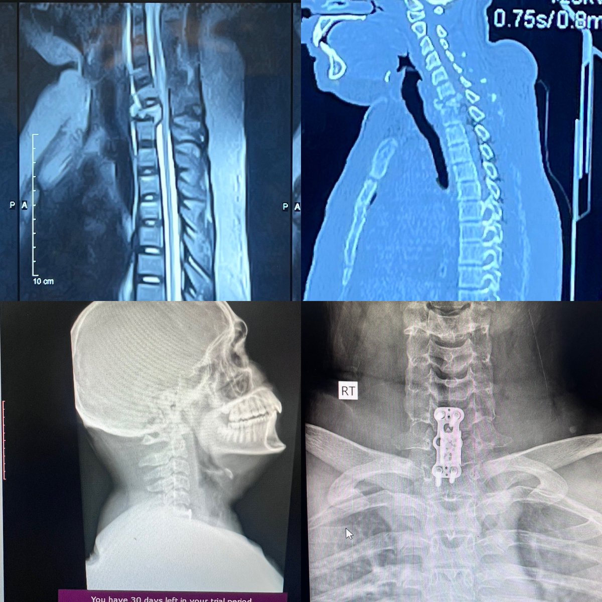 14 years old boy sustained neck injury while diving into shallow water in #lahorecanal become quadriplegic due to fracture of C7. ACCF with mesh cage and plate was done. #MedTwitter #OrthoTwitter #spine