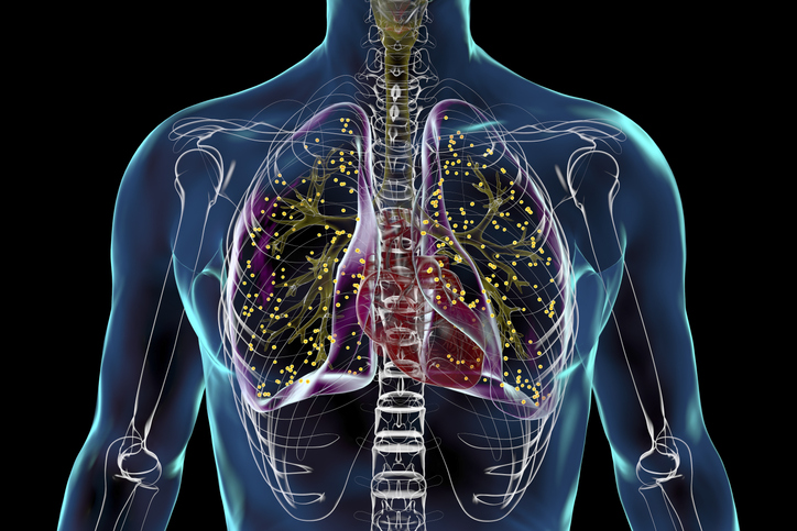 More than 80% of patients initiating tuberculosis treatment did not meet recommended CDC/NTCA inclusion criteria for treatment with isoniazid, rifapentine, moxifloxacin, and pyrazinamide. #pulmtwitter #pulmonology

brnw.ch/21wJbva