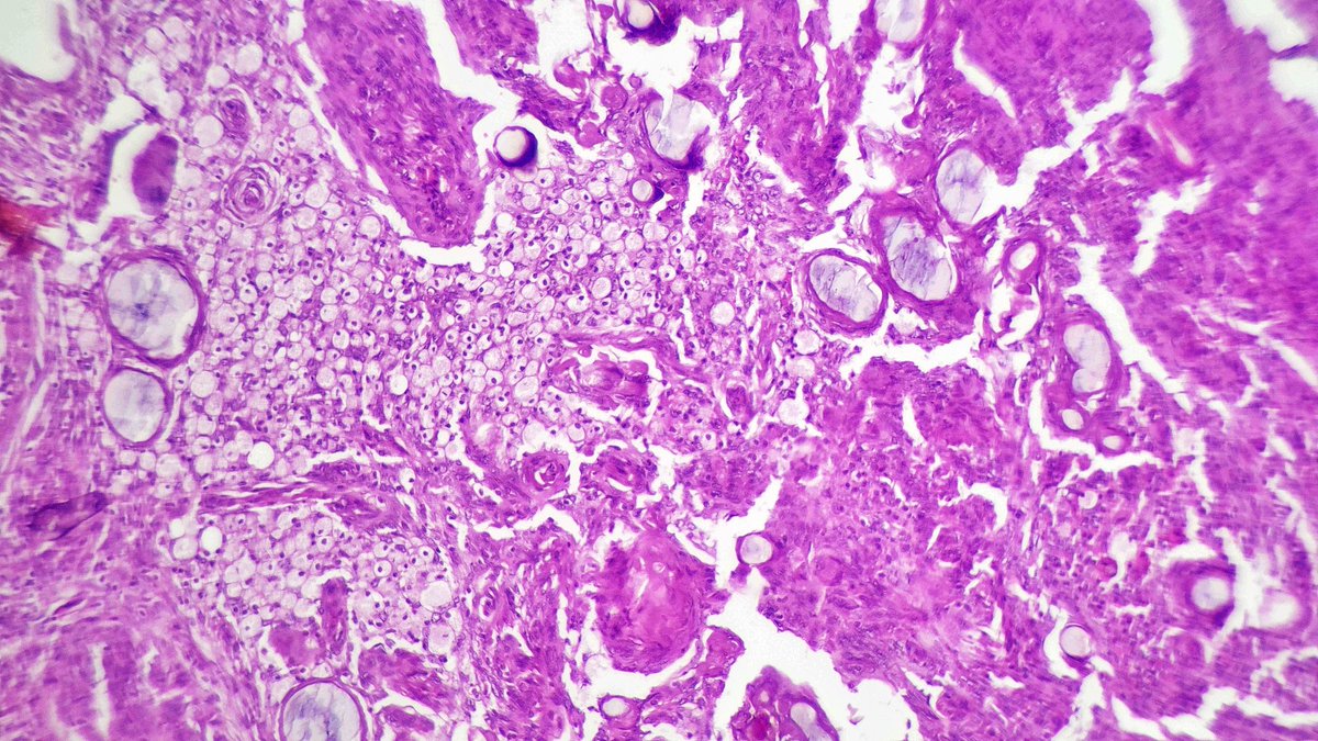 Drmerm's tweet image. A 71-year-old man presenting with frontal syndrome and headaches. Frontal meningioma. What do you think?
#PathTwitter #pathology  #medpath #MedTwitter #xpath #pathtweetaward #neuropath #meningioma  #BrainTumor   #PathBoards #patologia #neurooncology #pathart  #brain #neurosurgery