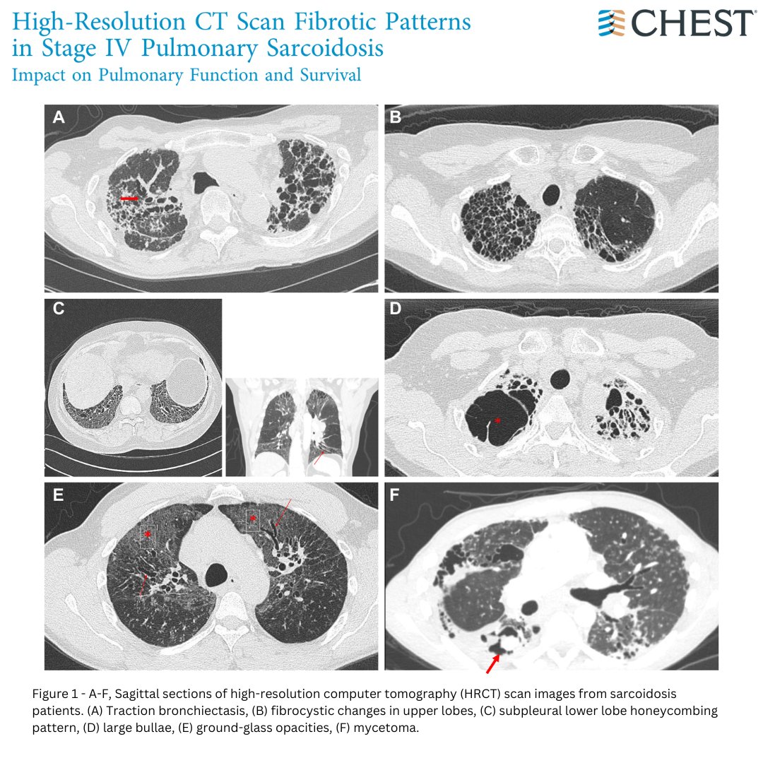 Will a detailed description of the extent and pattern of high-resolution CT scan fibrosis in patients with stage IV pulmonary sarcoidosis impact pulmonary function and survival? Read the full research in the April issue: hubs.la/Q02t_n730 #JournalCHEST #MedEd