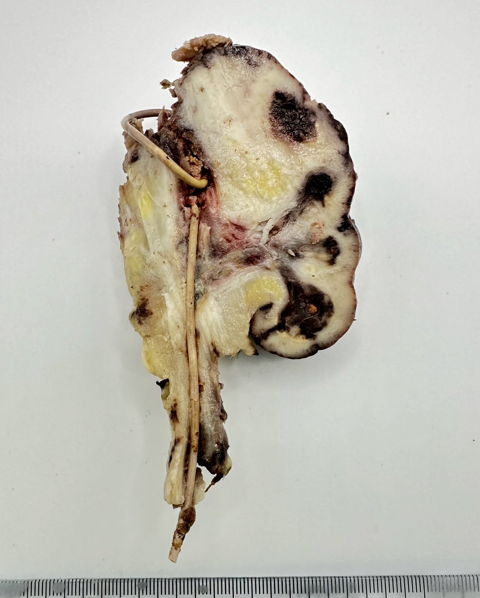 lorenaevilla's tweet photo. Obstructive uropathy. Double-J stent. cortical atrophy, diffuse interstitial fibrosis and blunting of calyces #pathology #pathologist #PathTwitter #pathAward #uropathology https://t.co/OTf3LYouX6