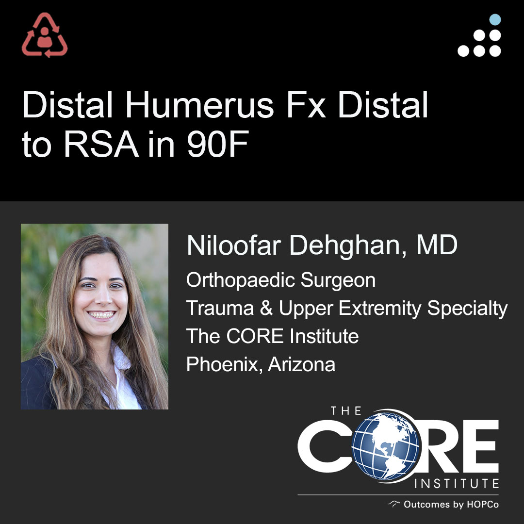 Here is a new case by Dr. Niloofar Dehghan and The CORE Institute (@CORE_Institute). DISTAL HUMERUS FX DISTAL TO RSA IN 90F How would you manage this #orthotwitter? Vote on this case for CME: orthobullets.tiny.us/yckwhyue