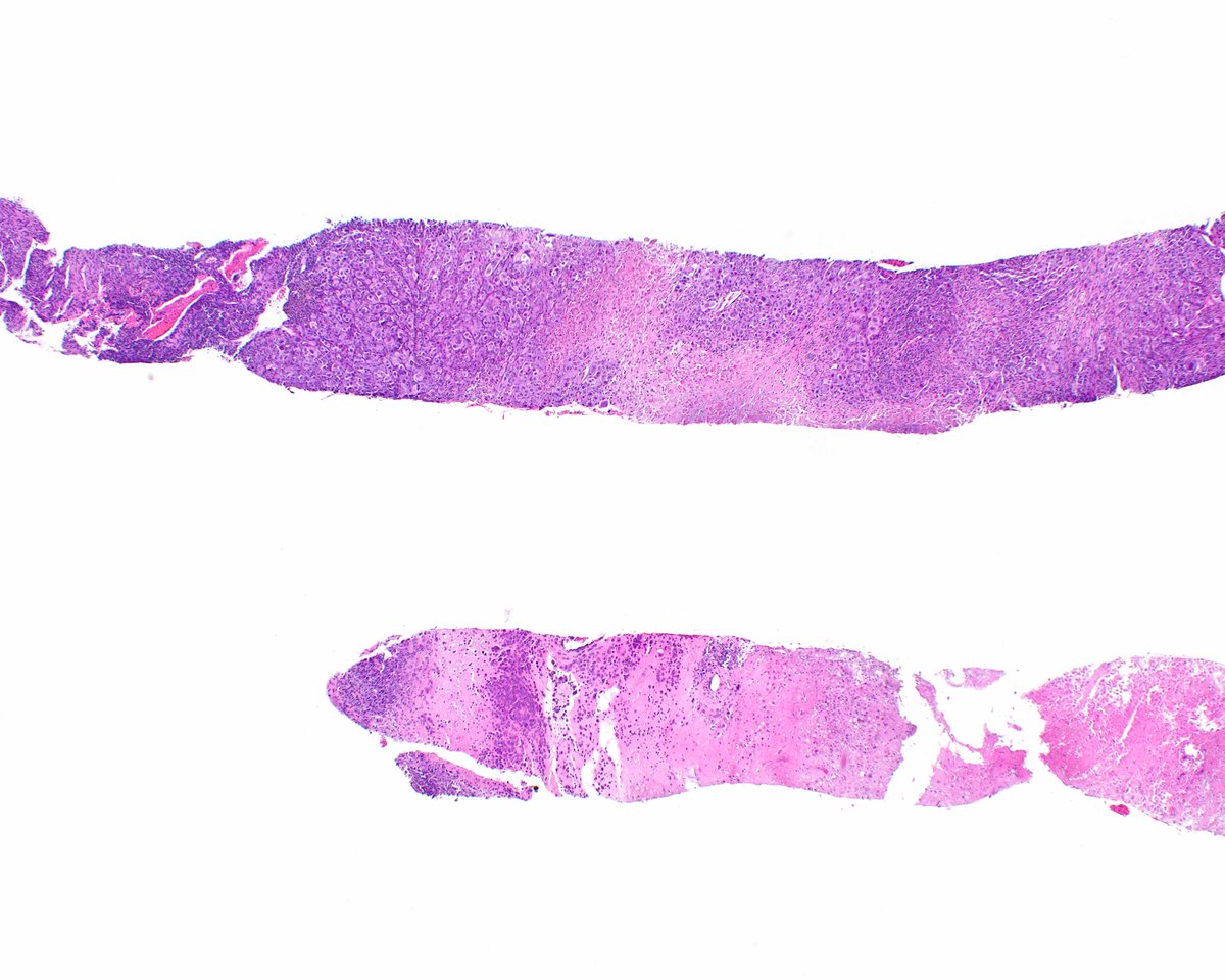 Proximal type epithelioid sarcoma can mimic carcinoma and melanoma alike.  This example showed strong keratin expression and loss of INI1/SMARCB1. innovativesciencepress.com